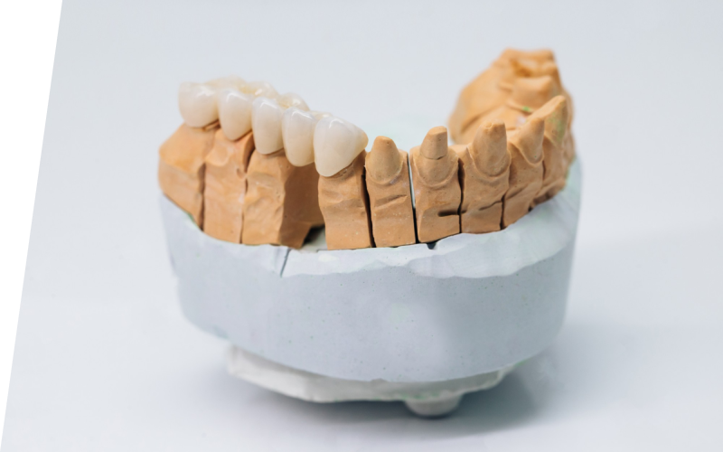 Коронка на зуб Коронка на зуб