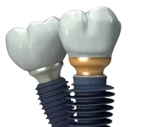 Экспресс имплантация зубов