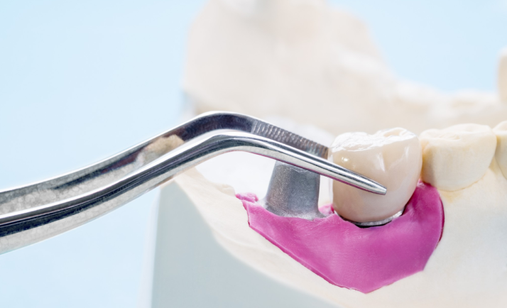 Керамические коронки без металла