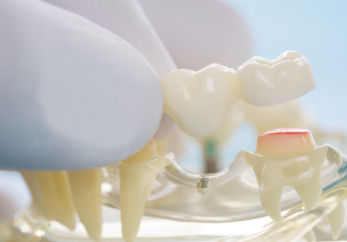 Коронки из диоксида циркония